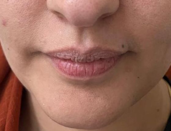 Before Treatment