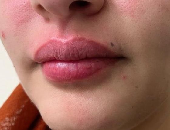 After Treatment