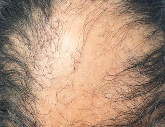 Before Treatment
