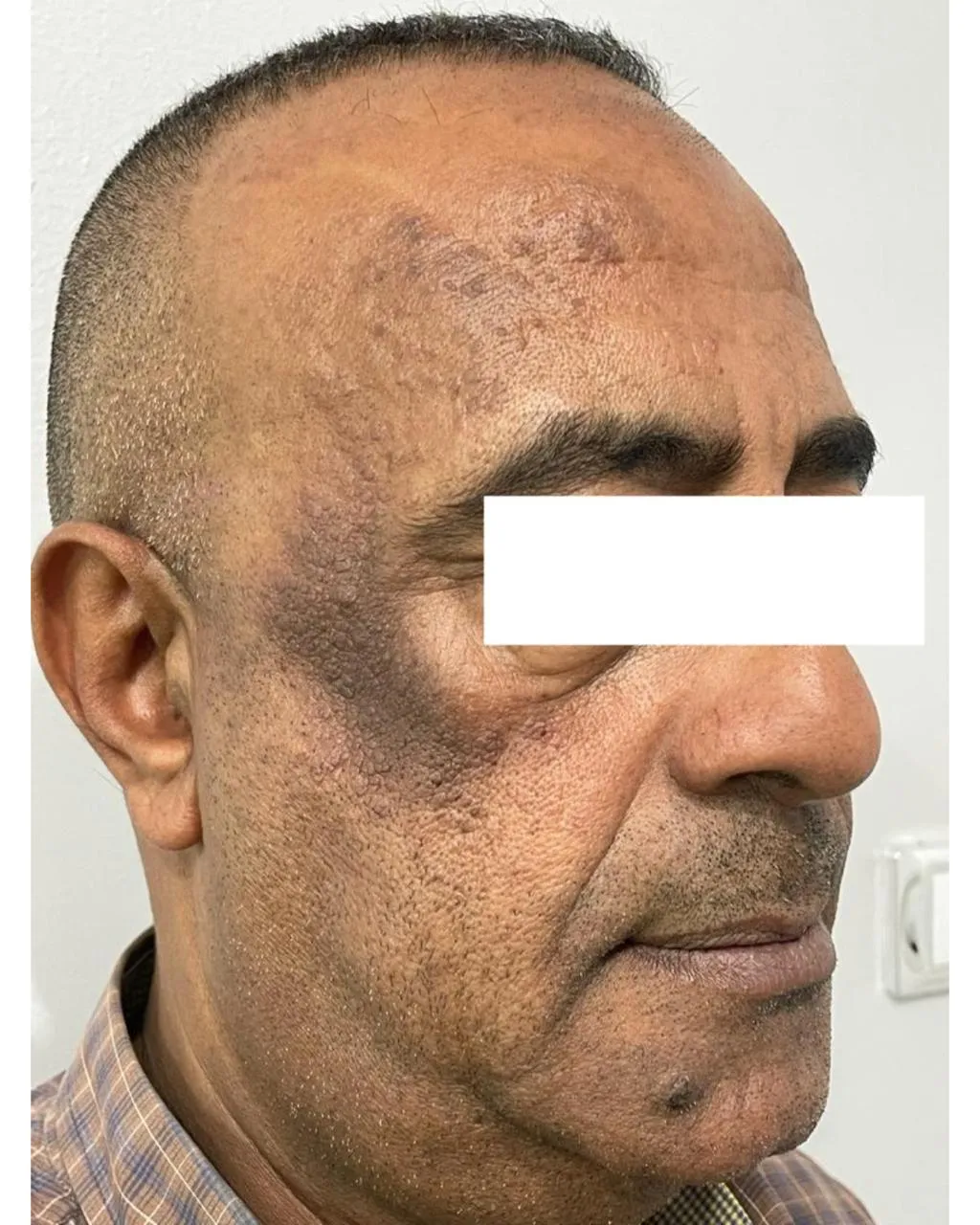 Before Treatment