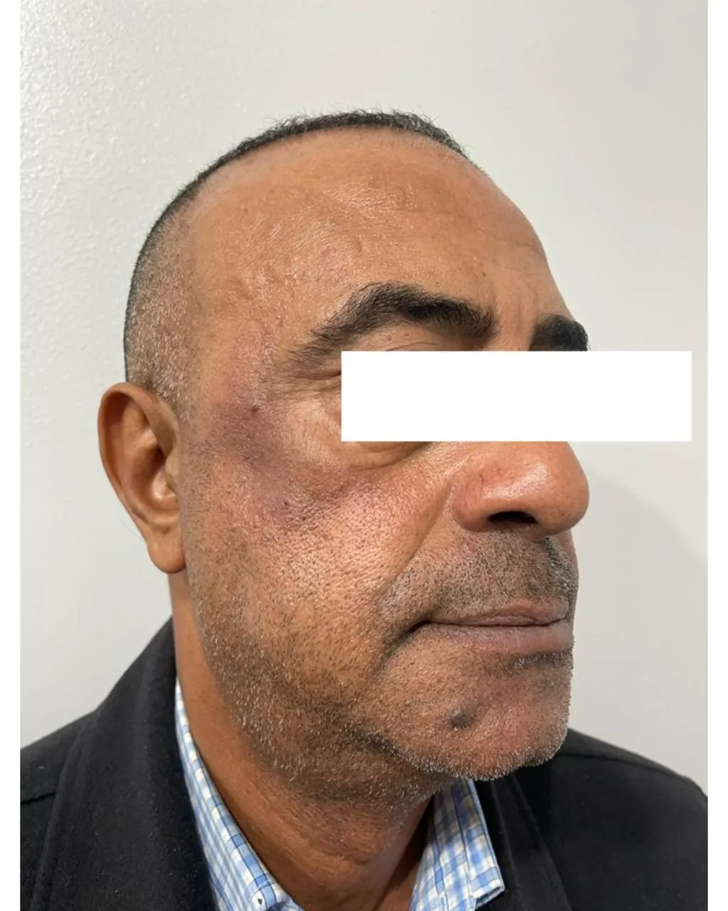 After Treatment