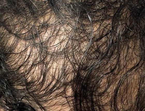 After Treatment