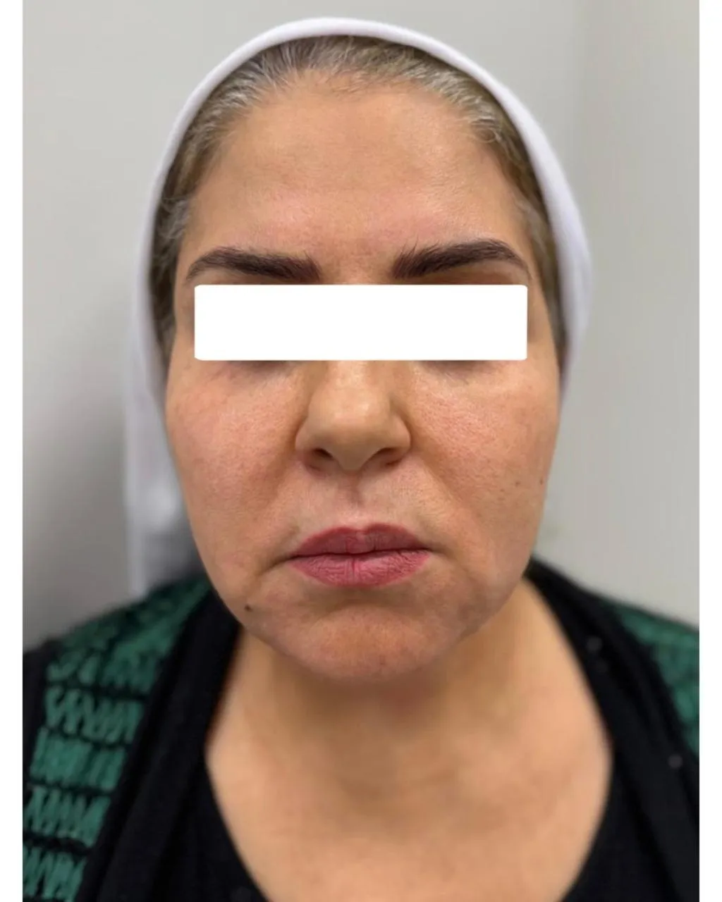 Before Treatment