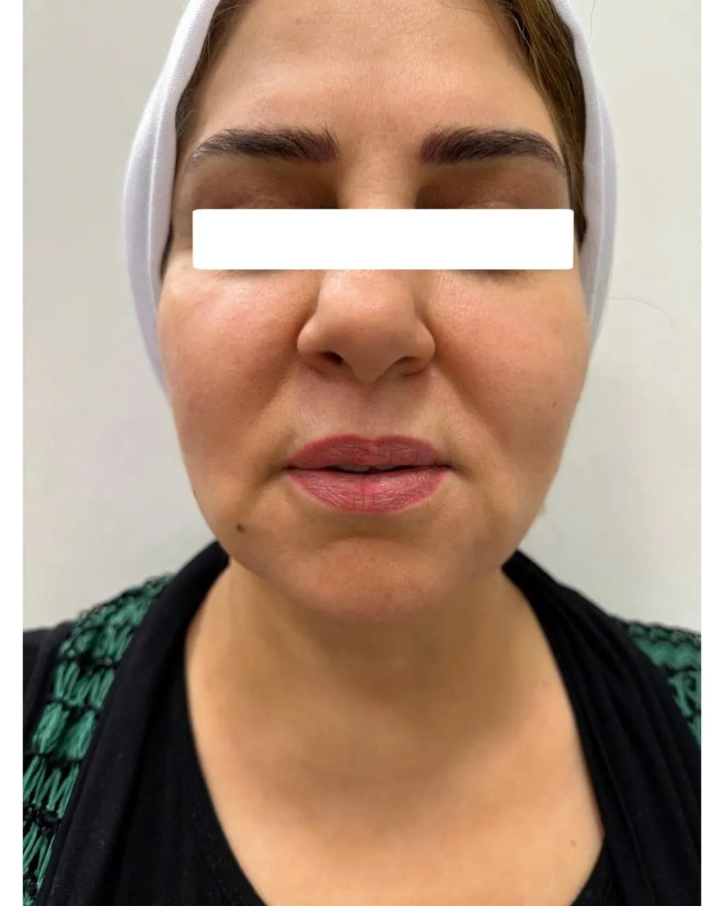 After Treatment