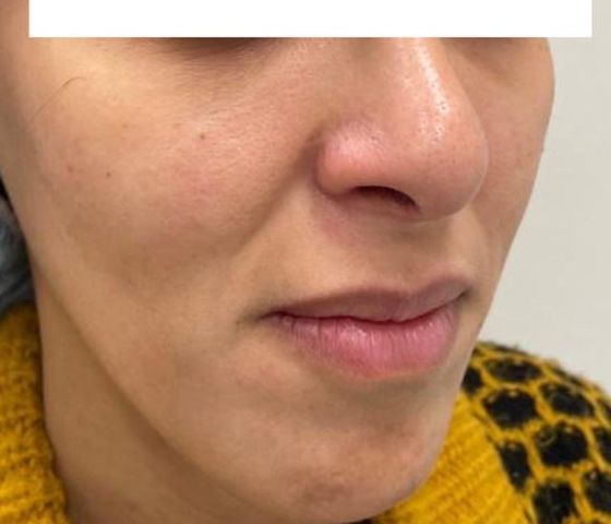 Before Treatment