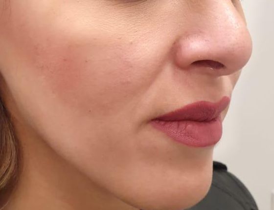 After Treatment