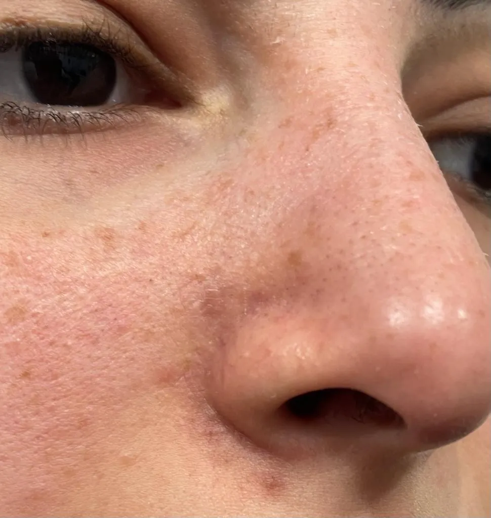 After Treatment