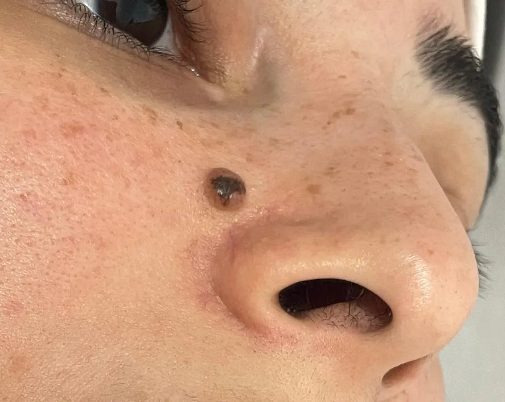 Before Treatment